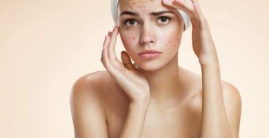 cbd-y-acne